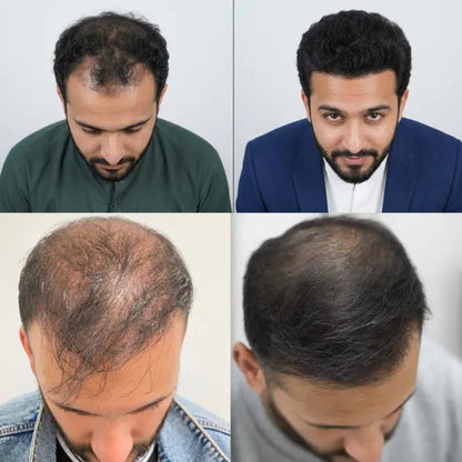 2in1 Bundle- Hair Growth Oil & Hair Serum(Free Shipping)